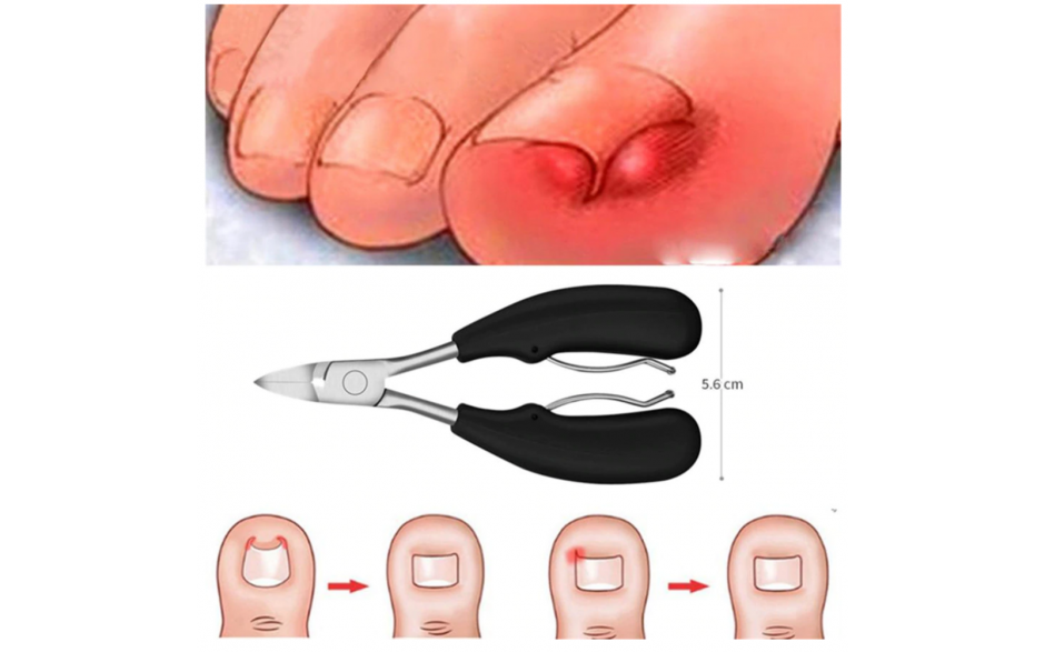 Nagelschaar nagelknipper tegen ingegroeide teennagels Pedicure / HaverCo